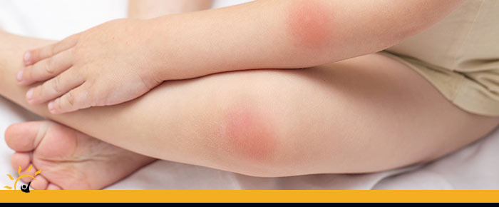 Skin Infections Treatment Clinic Near Me in Ellington CT, Unionville CT, East Haven CT, Cromwell CT, Oxford CT, and Newington CT Skin Infections Treatment Clinic Near Me in Ellington CT, Unionville CT, East Haven CT, Cromwell CT, Oxford CT, and Newington CT