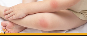 Skin Infections Treatment Clinic Near Me in Ellington CT, Unionville CT, East Haven CT, Cromwell CT, Oxford CT, and Newington CT Skin Infections Treatment Clinic Near Me in Ellington CT, Unionville CT, East Haven CT, Cromwell CT, Oxford CT, and Newington CT