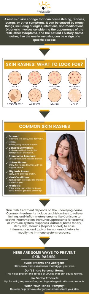 Skin rashes can occur from a variety of factors, including infections, heat, allergens, immune system disorders and medications. Do you have a skin rash and need help treating it? Visit Priority Urgent Care & Walk In Clinic, we specialize in providing the best care for your day-to-day problems. For more information, please contact us or schedule an appointment online. We have convenient locations to serve you in Ellington CT, Unionville CT, East Haven CT, Cromwell CT, Oxford, CT and Newington, CT.